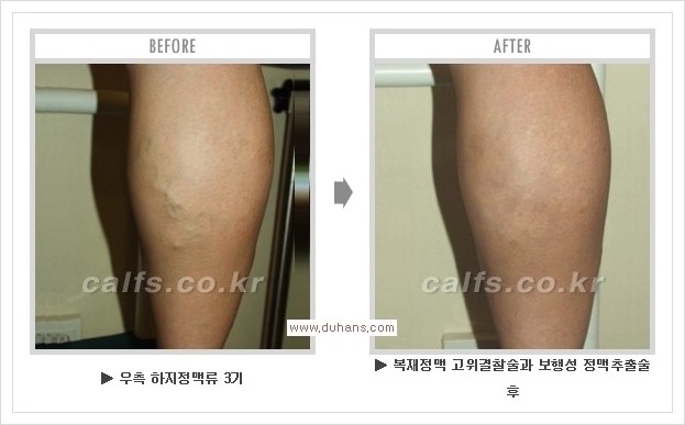 [두한성형외과 경쟁력 멀티종아리성형] - [종아리성형 방법별 전후 주의사항] 관련 이미지 36