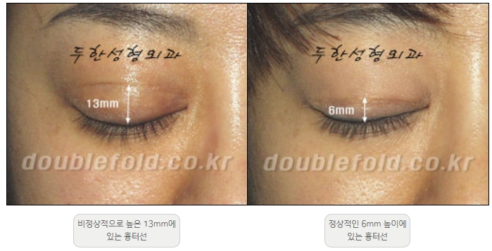 [Duhan Plastic Surgery Double Eyelid Revision] - [Thick Double Eyelid Line] image 2