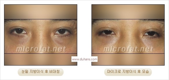 [두한성형외과 경쟁력 지방이식] - [지방이식 부작용 종류와 지방이식 부작용 교정 방법] 관련 이미지 29