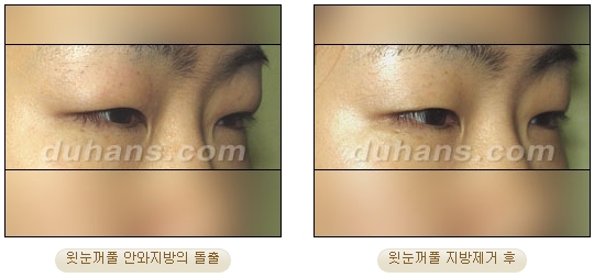두한성형외과 지방제거 - 눈밑지방, 눈꺼풀지방제거 관련 이미지 10
