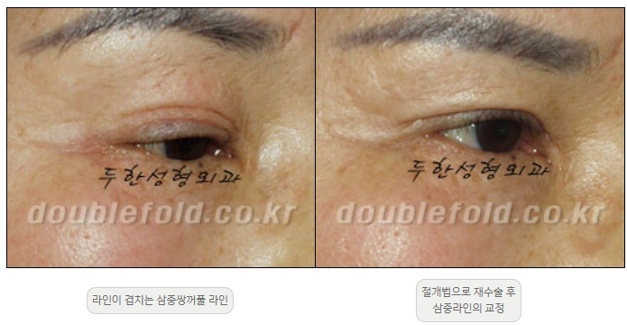 [Double Eyelid Surgery Duhan Plastic Surgery] - [Revision Methods] image 25