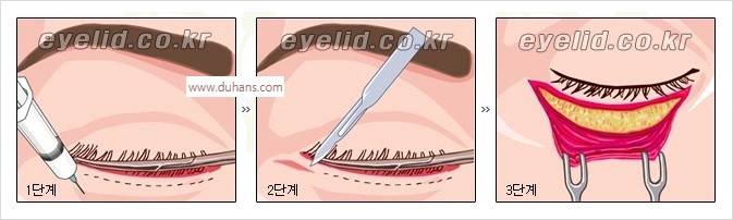 [두한성형외과 경쟁력 안검성형] - [눈밑주름 제거수술] 관련 이미지 3