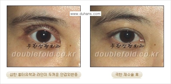 [두한성형외과 경쟁력 쌍꺼풀 재수술, 극한 눈재수술] - [망가진 쌍꺼풀 라인을 교정하는 극한 재수술을  위한 계획] 관련 이미지 5