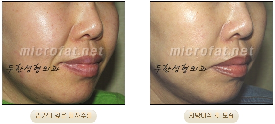 Wrinkle Improvement, Duhan Plastic Surgery - Mouth Lines, Nasolabial Folds image 15