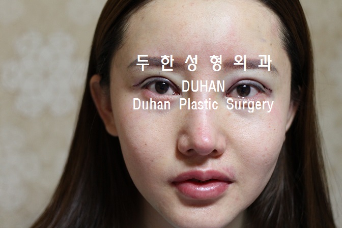 큰 아웃라인,#안검하수 #눈재수술, #애교살 #지방이식 관련 이미지 4