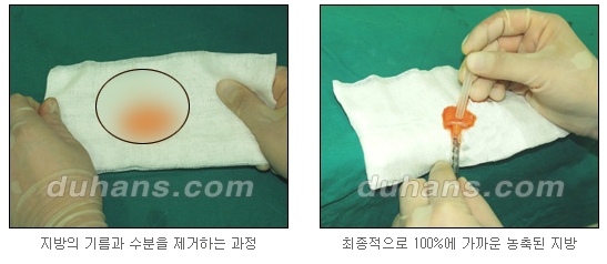 [두한성형외과 얼굴자가지방이식] - [지방이식 과정] 관련 이미지 14
