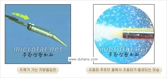 [두한성형외과 경쟁력 지방흡입] - [얼굴, 볼살, 턱살, 턱선의 초음파 지방흡입] 관련 이미지 5