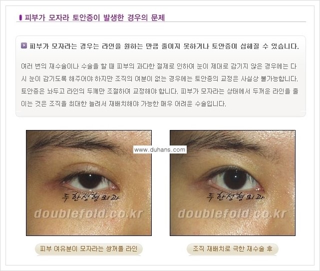 [두한성형외과 경쟁력 쌍꺼풀 재수술, 극한 재수술] - [재수술에서 극복해야 할 극한의 상황과 문제들 안내] 관련 이미지 6