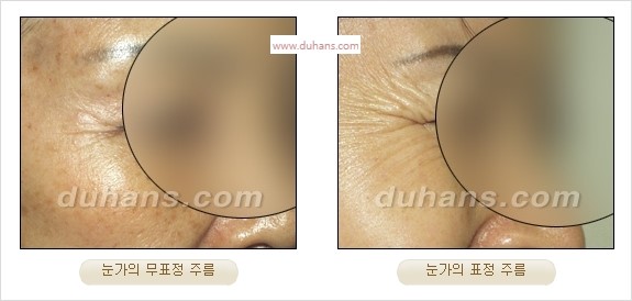 [두한성형외과 경쟁력 주름성형] - [주름제거를 위한 리프팅] 관련 이미지 5