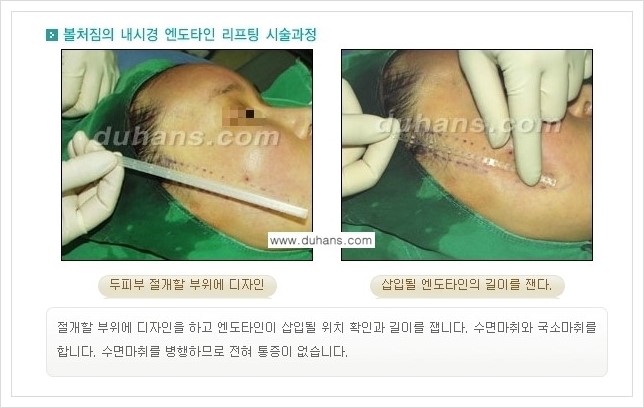 [두한성형외과 경쟁력 주름교정술] - [엔도타인 리프팅 안내 ②] 관련 이미지 4