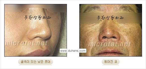 [두한성형외과 경쟁력 코성형] - [미세지방이식을 이용한 자연스러운 코성형 안내] 관련 이미지 3