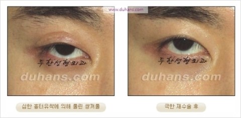 ​[두한성형외과 눈재수술] - [앞트임복원, 뒤트임복원, 쌍꺼풀복원] 관련 이미지 18