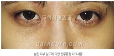 [두한성형외과 다크서클] - [하안검성형술] 관련 이미지 2