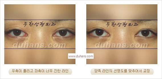 [두한성형외과 경쟁력 눈성형] - [나에게 맞는 어울리는 쌍꺼풀 라인] 관련 이미지 33