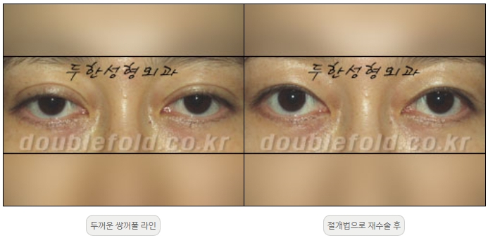 [Duhan Plastic Surgery Double Eyelid Revision] - [Thick Double Eyelid Line] image 12