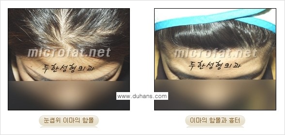 [두한성형외과의 경쟁력 미세지방이식] - [이마 미세지방이식 안내 ①] 관련 이미지 3