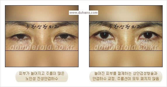 [두한성형외과 경쟁력 쌍꺼풀 재수술, 극한 재수술] - [쌍꺼풀 재수술에서 극복해야 할 극한의 상황과 문제들] 관련 이미지 14