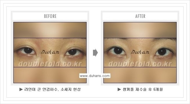 [두한성형외과 경쟁력 쌍꺼풀 재수술, 극한 재수술] - [과한 눈매교정 안내] 관련 이미지 7