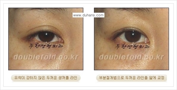 [두한성형외과 경쟁력 눈성형] - [부분절개법으로 두껍고 어색한 라인 교정 안내 2.] 관련 이미지 3