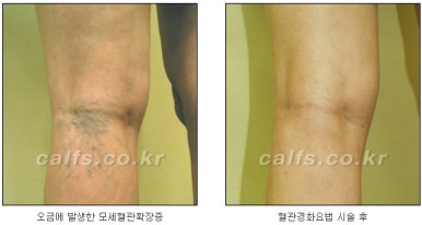 [Duhan Plastic Surgery Calf Clinic] - [Calf Contouring Guide] image 39