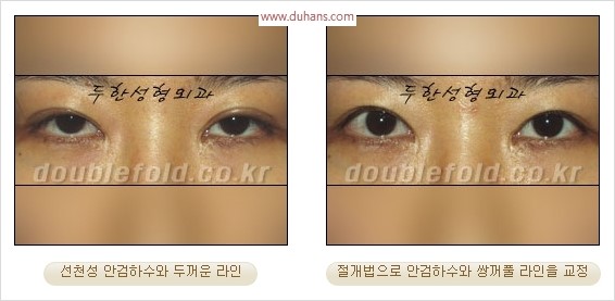 [두한성형외과 경쟁력 눈성형] - [극한 재수술, 함몰된 눈꺼풀 라인교정, 안검하수(졸리운 눈매)] 관련 이미지 103