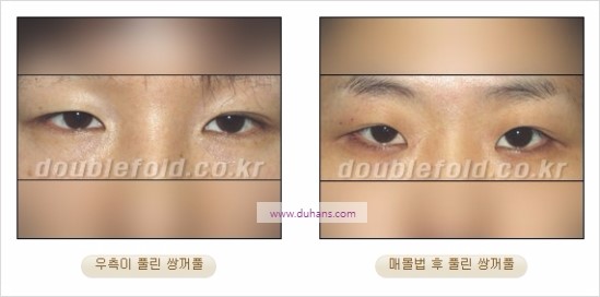 [두한성형외과 경쟁력 쌍꺼풀 재수술] - [풀린 라인 교정(Correction released fold line) 방법] 관련 이미지 1