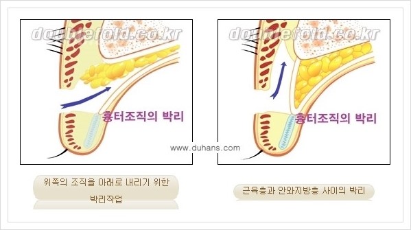 [두한성형외과 경쟁력 쌍꺼풀 재수술] - [두껍고 어색한 라인 교정하는 방법 안내 2.] 관련 이미지 2