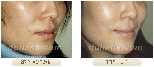 Duhan Plastic Surgery Laser Treatment - Mole Removal, Spot Removal, Melasma, Blemishes, Hyperpigmentation, Skin Tone Improvement, Elasticity Improvement, Skin Texture Improvement image 34