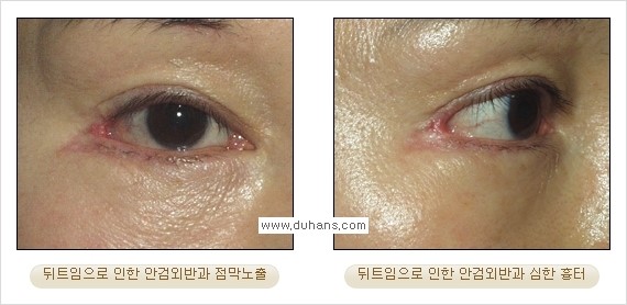 [두한성형외과 경쟁력 쌍꺼풀 재수술, 극한 눈재수술] - [뒤트임 수술의 부작용 안내] 관련 이미지 7