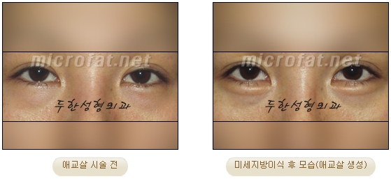 ​[두한성형외과 지방이식] - [애교살] 관련 이미지 11
