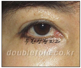 [DuHan Plastic Surgery Eye Surgery] - [Guide to Epicanthoplasty and Canthoplasty for Increasing the Horizontal Width of the Eyes] image 25