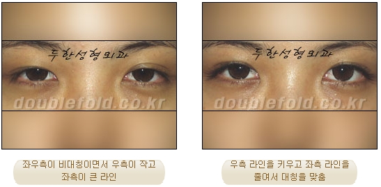 [두한성형외과 쌍커풀수술] - [눈성형 방법에 대한 자주하는 질문과 답변] 관련 이미지 40