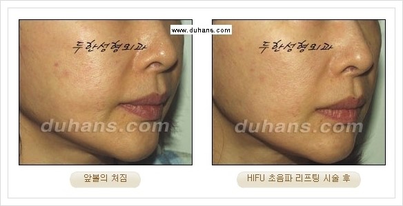 [두한성형외과 경쟁력 주름성형] - [HIFU 초음파 리프팅 주름교정술 안내 2.] 관련 이미지 15