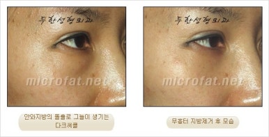 두한성형외과 눈밑수술 - 다크서클 수술 전후 관리 안내 관련 이미지 58