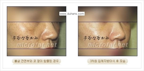 [두한성형외과 경쟁력 미세지방이식] - [귀족수술과 인디언밴드 교정 안내] 관련 이미지 10