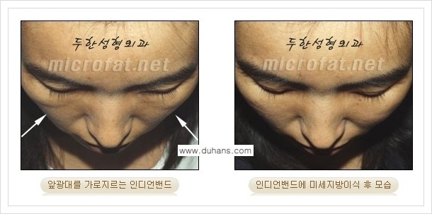 [두한성형외과의 경쟁력 미세지방이식] - [귀족수술 + 인디언밴드 미세지방이식 안내] 관련 이미지 3