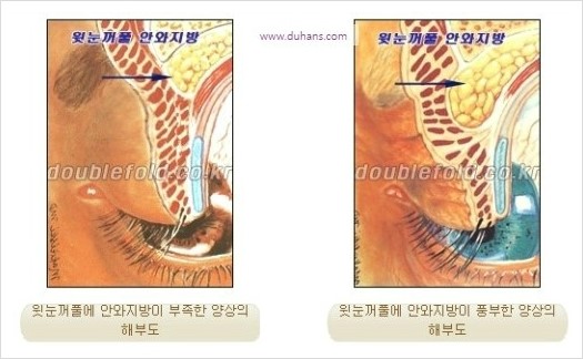 [두한성형외과 경쟁력 눈성형 리더] - [미세지방이식으로 눈매와 쌍꺼풀 라인을 교정] 관련 이미지 12
