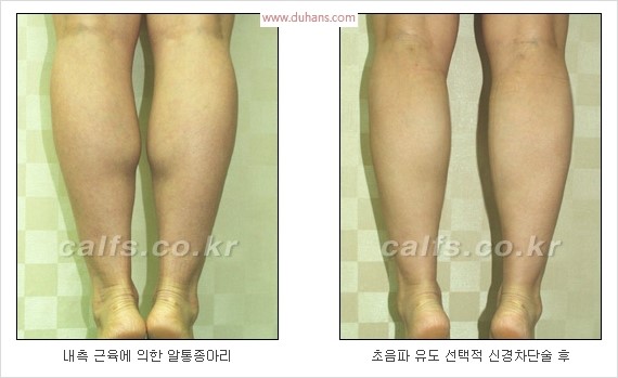 [두한성형외과 경쟁력 종아리성형 리더] - [종아리성형 실패의 원인과 원인에 따른 적합한 시술 방법] 관련 이미지 10