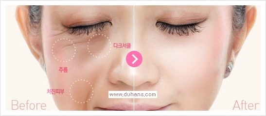 [두한성형외과 경쟁력 다크써클 치료] - [다크써클 + 엔도타인 리프팅 콤비 프로그램] 관련 이미지 1