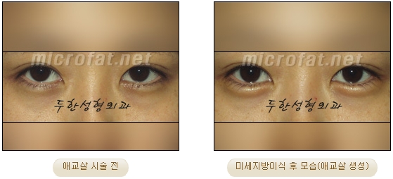 ​[두한성형외과 지방이식] - [애교살] 관련 이미지 23
