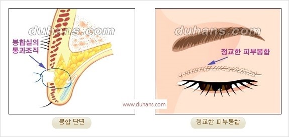 [두한성형외과 경쟁력 눈성형] - [완전절개법(Full incision method)의 재수술 과정] 관련 이미지 7