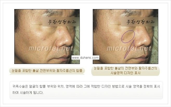 [두한성형외과 경쟁력 미세지방이식] - [귀족수술과 인디언밴드(앞광대주름) 미세지방이식] 관련 이미지 4