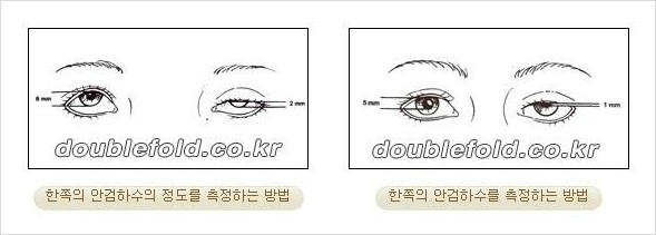 [두한성형외과 경쟁력 눈성형] - [안검하수(졸리운 눈매)의 종류와 교정 방법 안내] 관련 이미지 3