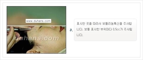 [두한성형외과 경쟁력 주름교정] - [간단 주사요법 - 보톡스 시술 안내 ①] 관련 이미지 7