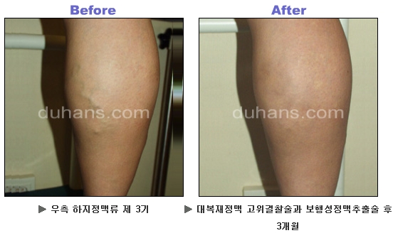 [두한성형외과 정맥류] - [하지정맥류, 정맥확장증, 혈관확장증] 관련 이미지 26