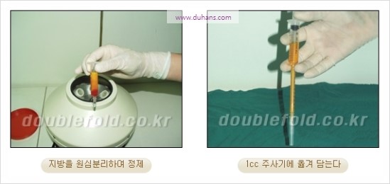 [두한성형외과 경쟁력 눈성형] - [쌍꺼풀 재수술 과정과 쌍꺼풀 재수술 실패의 원인, 쌍꺼풀 재수술의 성공 요건] 관련 이미지 22