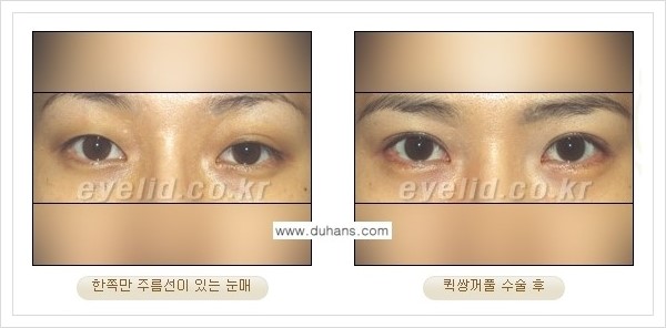 [두한성형외과 경쟁력 눈성형] - [퀵쌍꺼풀 수술] 관련 이미지 12