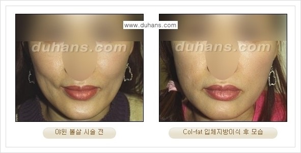 [두한성형외과 경쟁력 미세지방이식] - [지방이식 특허 Col-fat 미세지방이식 성공사례 안내] 관련 이미지 15