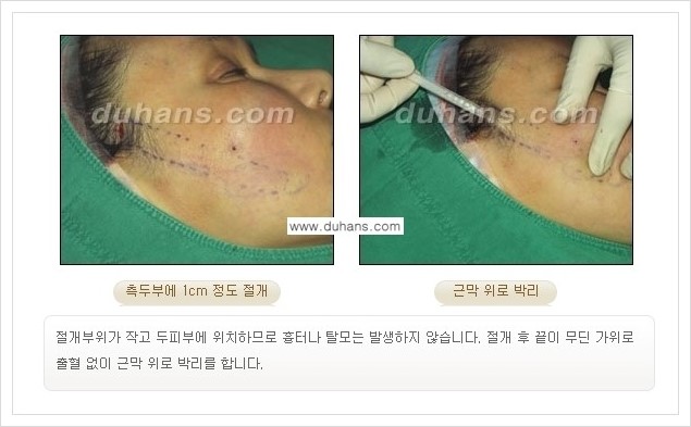 [두한성형외과 경쟁력 주름성형] - [주름제거 방법 안내] 관련 이미지 9