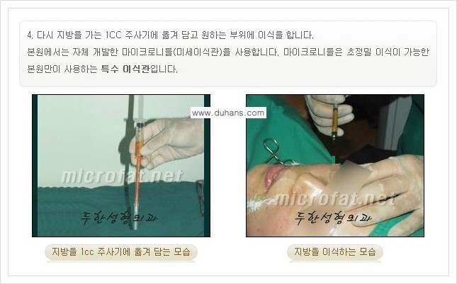 [두한성형외과 경쟁력 미세지방이식] - [귀족수술과 인디언밴드(앞광대주름) 미세지방이식] 관련 이미지 9